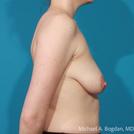 Before image 3 Case #112071 - Breast Augmentation