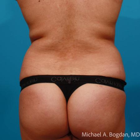 Before image 5 Case #112086 - Abdominoplasty