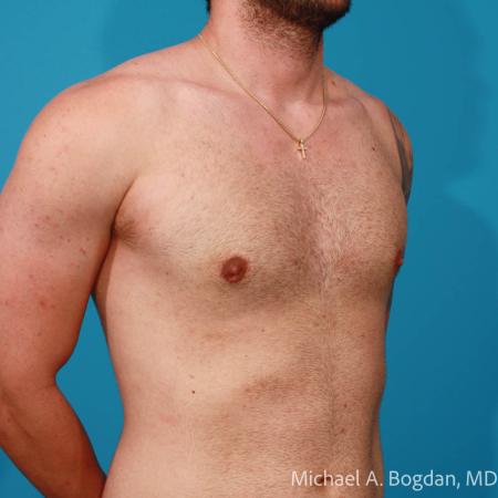After image 2 Case #112216 - Bilateral Gynecomastia Excision