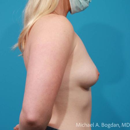 Before image 3 Case #112201 - Breast Augmentation