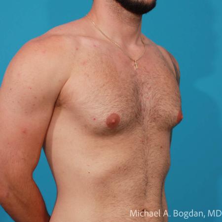 Before image 2 Case #112216 - Bilateral Gynecomastia Excision