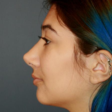 After image 3 Case #112051 - Female Rhinoplasty