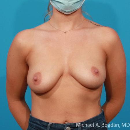 Before image 1 Case #112211 - Breast Augmentation