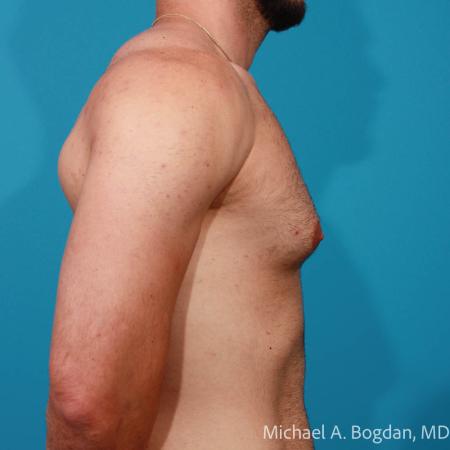 Before image 3 Case #112216 - Bilateral Gynecomastia Excision