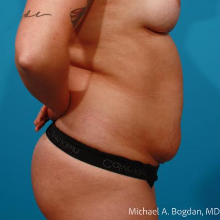 Before image 3 Case #112086 - Abdominoplasty