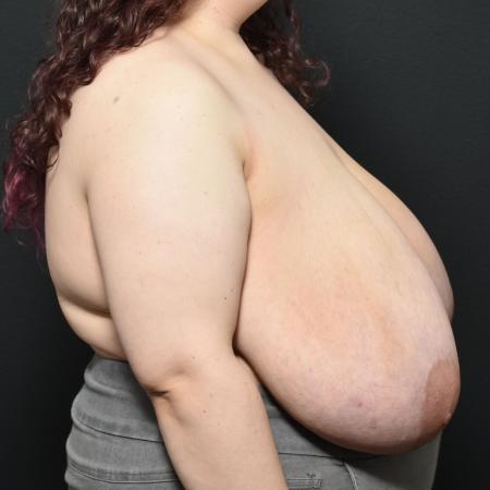 Before image 3 Case #112246 - Breast Reduction