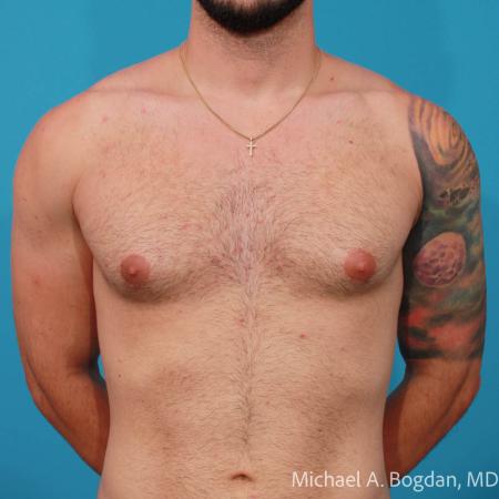 Before image 1 Case #112216 - Bilateral Gynecomastia Excision