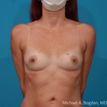 Before image 1 Case #112076 - Breast Augmentation