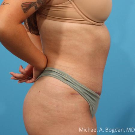 After image 3 Case #112086 - Abdominoplasty