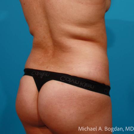 Before image 4 Case #112086 - Abdominoplasty