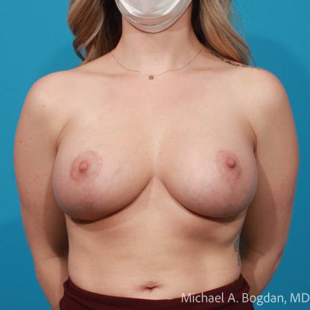 After image 1 Case #112211 - Breast Augmentation