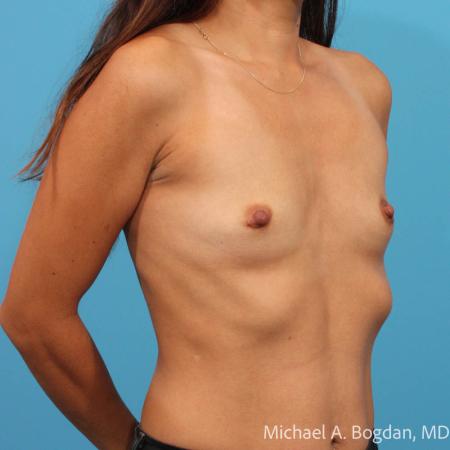 Before image 2 Case #112046 - Breast Augmentation