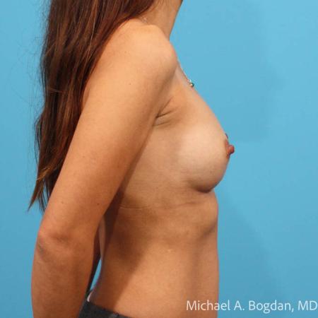 After image 3 Case #112046 - Breast Augmentation