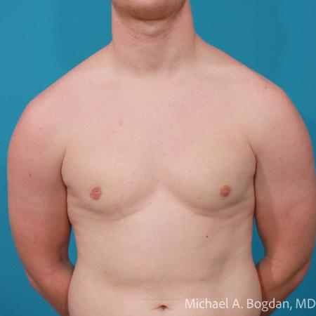 After image 1 Case #112221 - Bilateral Gynecomastia Excision