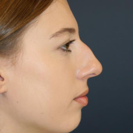 Before image 3 Case #112101 - Female Rhinoplasty