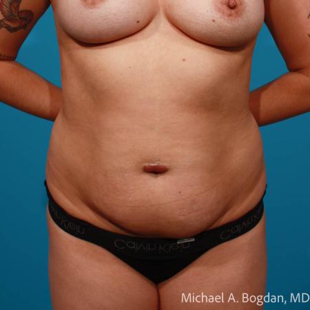 Before image 1 Case #112086 - Abdominoplasty