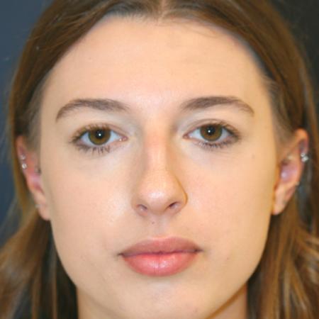 Before image 1 Case #112101 - Female Rhinoplasty