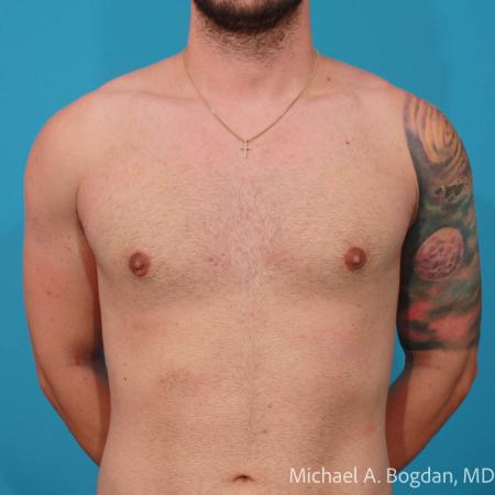 After image 1 Case #112216 - Bilateral Gynecomastia Excision