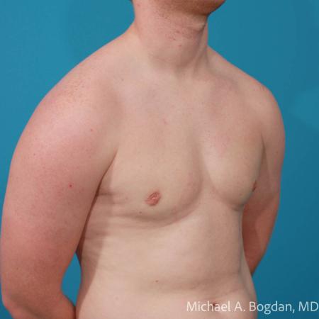 After image 2 Case #112221 - Bilateral Gynecomastia Excision