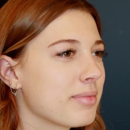 After image 2 Case #112101 - Female Rhinoplasty