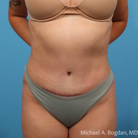 After image 1 Case #112086 - Abdominoplasty