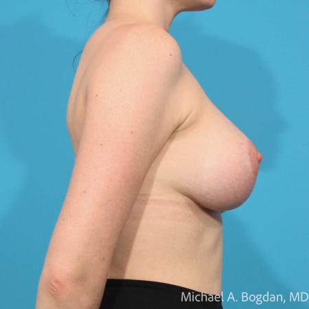 After image 3 Case #112071 - Breast Augmentation