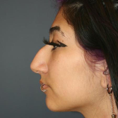 Before image 3 Case #112051 - Female Rhinoplasty