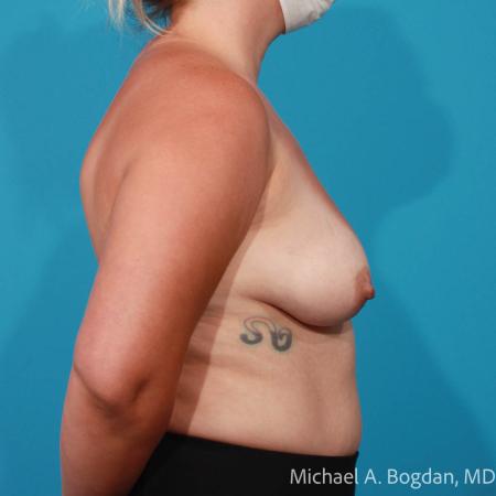 Before image 3 Case #112016 - Bilateral Augmentation Mastopexy