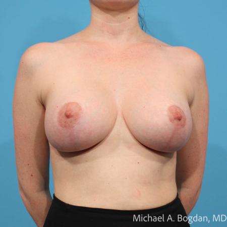 After image 1 Case #112071 - Breast Augmentation