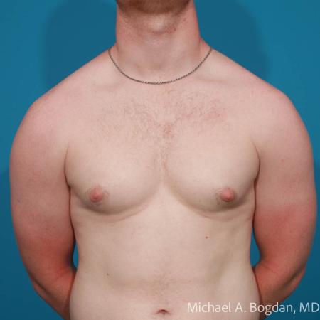 Before image 1 Case #112221 - Bilateral Gynecomastia Excision