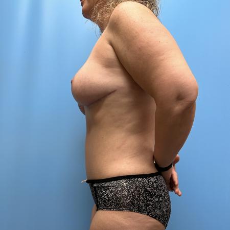 After image 3 Case #111986 - Mommy Makeover 2