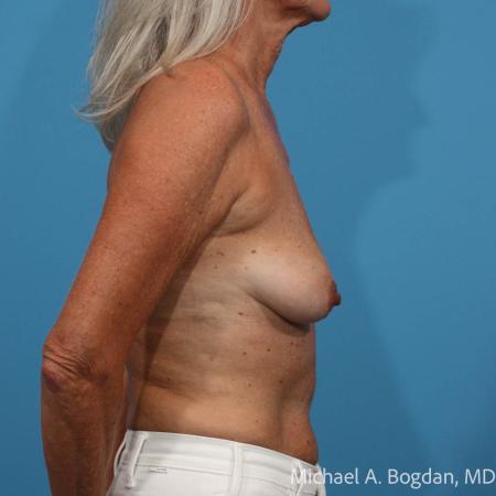 Before image 3 Case #114231 - Bilateral Augmentation Mastopexy