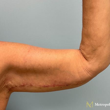 After image 1 Case #112291 - Brachioplasty