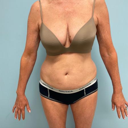 Before image 1 Case #112266 - Liposuction