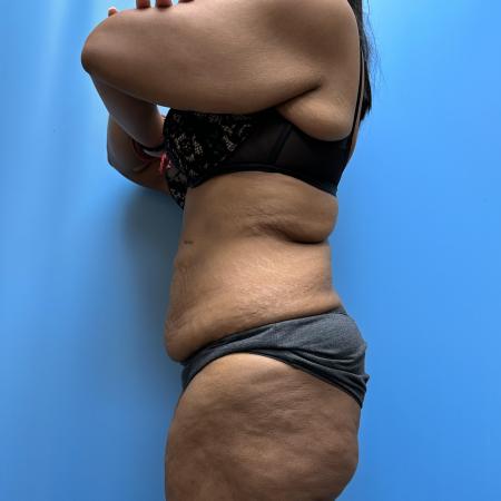 Before image 3 Case #112356 - Body Lift/360 Tummy Tuck