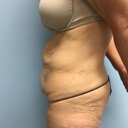 Before image 3 Case #112271 - Abdominoplasty