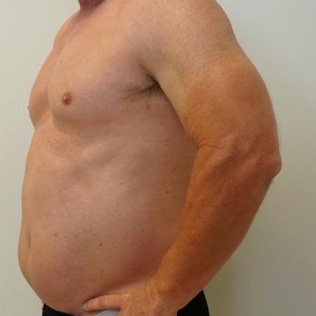 Before image 2 Case #112466 - Hi-Definition Liposuction (male)