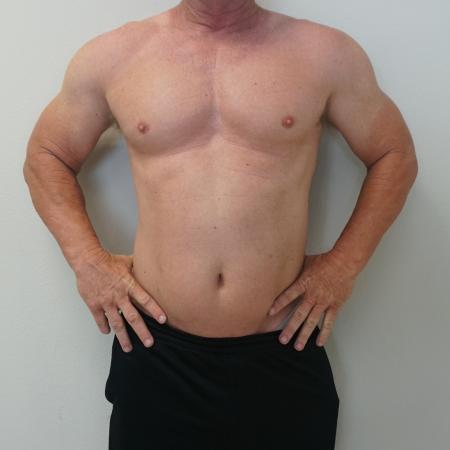 Before image 1 Case #112466 - Hi-Definition Liposuction (male)