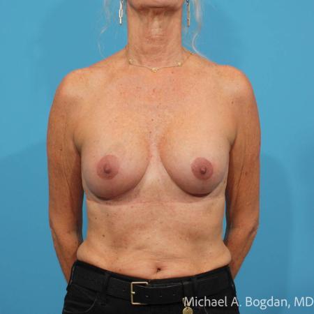 After image 1 Case #114231 - Bilateral Augmentation Mastopexy