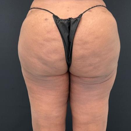 After image 3 Case #112451 - Hi-Definition Abdominoplasty with Renuvion