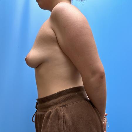 Before image 3 Case #112361 - Breast lift with implants