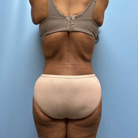 After image 5 Case #112356 - Body Lift/360 Tummy Tuck