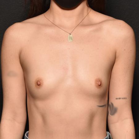 Before image 1 Case #112336 - Breast Augmentation*