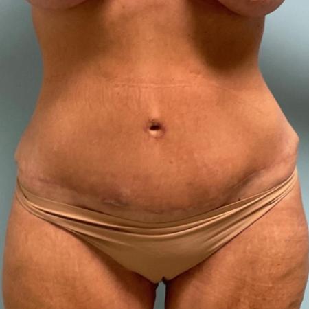 After image 1 Case #112281 - Abdominoplasty