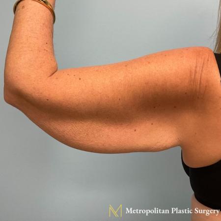 Before image 2 Case #112291 - Brachioplasty