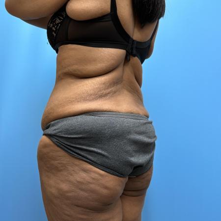 Before image 4 Case #112356 - Body Lift/360 Tummy Tuck
