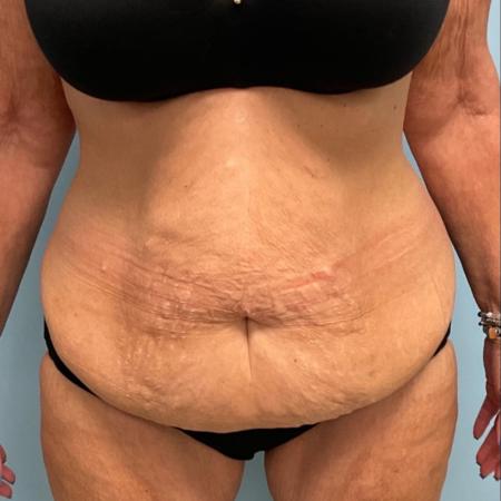 Before image 1 Case #112281 - Abdominoplasty