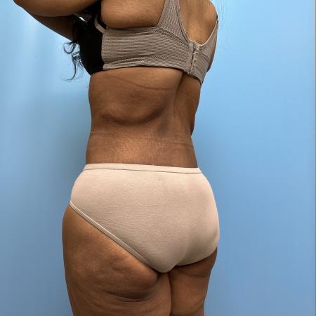 After image 4 Case #112356 - Body Lift/360 Tummy Tuck