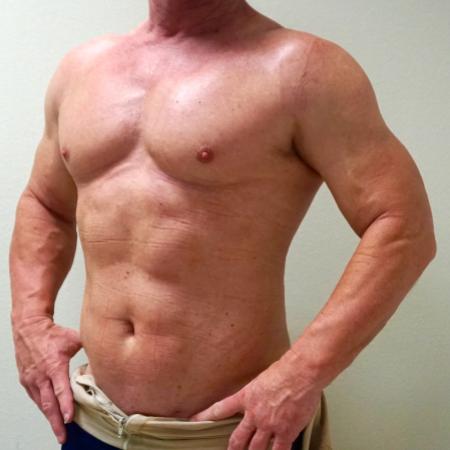 After image 2 Case #112466 - Hi-Definition Liposuction (male)