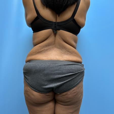 Before image 5 Case #112356 - Body Lift/360 Tummy Tuck
